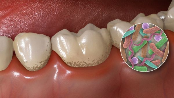 Разница между зубным налетом и камнем: влияние на здоровье полости рта