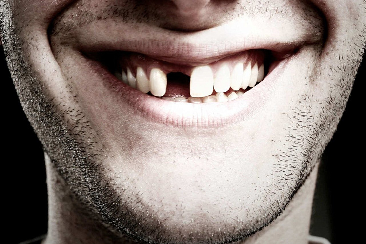 Нет 1 зуба: чем опасно и как решить проблему?